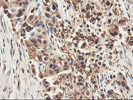IHC of paraffin-embedded Carcinoma of Human lung tissue using anti-RNPEP mouse monoclonal antibody. (Heat-induced epitope retrieval by 10mM citric buffer, pH6.0, 100C for 10min).