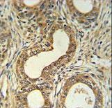 Roundabout 4 Antibody IHC of formalin-fixed and paraffin-embedded prostate carcinoma followed by peroxidase-conjugated secondary antibody and DAB staining. This data demonstrates the use of the Roundabout 4 Antibody for immunohistochemistry.