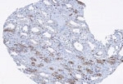 IHC of ASP in human pancreatic tumor tissue using LS-C618 at 1:100 dilution.