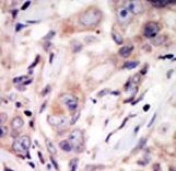 Formalin-fixed and paraffin-embedded human cancer tissue reacted with the primary antibody, which was peroxidase-conjugated to the secondary antibody, followed by DAB staining. This data demonstrates the use of this antibody for immunohistochemistry; clinical relevance has not been evaluated. BC = breast carcinoma; HC = hepatocarcinoma.