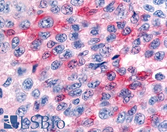 Anti-RORB / ROR Beta antibody IHC of human Skin, Melanoma. Immunohistochemistry of formalin-fixed, paraffin-embedded tissue after heat-induced antigen retrieval.