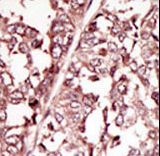 Formalin-fixed and paraffin-embedded human cancer tissue reacted with the primary antibody, which was peroxidase-conjugated to the secondary antibody, followed by DAB staining. This data demonstrates the use of this antibody for immunohistochemistry; clinical relevance has not been evaluated. BC = breast carcinoma; HC = hepatocarcinoma.