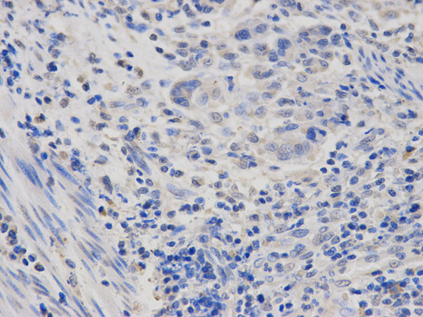Immunohistochemistry of paraffin-embedded human esophageal cancer using POLR2D antibody at dilution of 1:100 (400x lens).