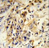 Formalin-fixed and paraffin-embedded human breast carcinoma reacted with RPGRIP1 Antibody , which was peroxidase-conjugated to the secondary antibody, followed by DAB staining. This data demonstrates the use of this antibody for immunohistochemistry; clinical relevance has not been evaluated.