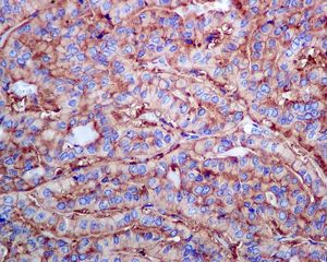 IHC of paraffin-embedded human thyroid gland adenocarcinoma tissue using anti-RPL13 antibody.