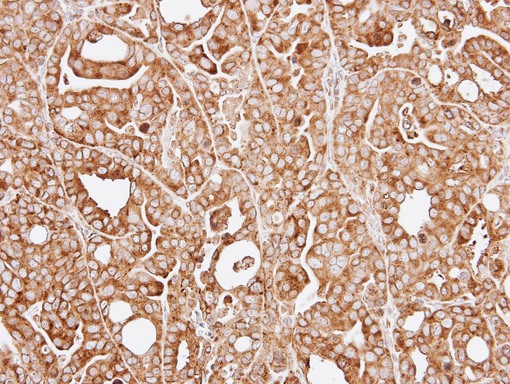 IHC of paraffin-embedded NCI-N87 xenograft using RPL13A antibody at 1:100 dilution.