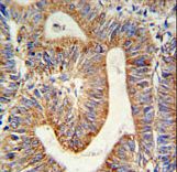 RPL17 Antibody IHC of formalin-fixed and paraffin-embedded colon carcinoma followed by peroxidase-conjugated secondary antibody and DAB staining.
