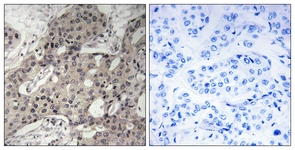 IHC of paraffin-embedded human breast carcinoma tissue, using RPL3 Antibody. The picture on the right is treated with the synthesized peptide.