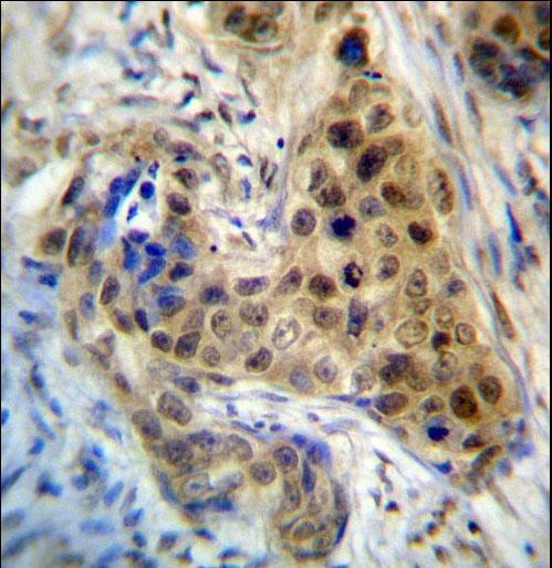RPL3 Antibody immunohistochemistry of formalin-fixed and paraffin-embedded human breast carcinoma followed by peroxidase-conjugated secondary antibody and DAB staining.