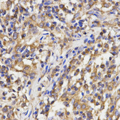 Immunohistochemistry of paraffin-embedded human lung cancer using RPL5 antibody at dilution of 1:200 (x400 lens)