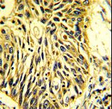 Formalin-fixed and paraffin-embedded human lung carcinoma with CD201 Antibody , which was peroxidase-conjugated to the secondary antibody, followed by DAB staining. This data demonstrates the use of this antibody for immunohistochemistry; clinical relevance has not been evaluated.