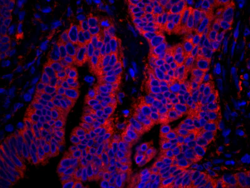 Detection of Human rpL7a/SURF3 by Immunohistochemistry. Sample: FFPE section of human colon carcinoma. Antibody: Affinity purified rabbit anti-rpL7a/SURF3 used at a dilution of 1:100. Detection: Red-fluorescent goat anti-rabbit IgG highly cross-adsorbed Antibody used at a dilution of 1:100.