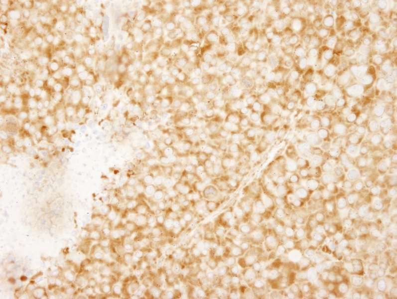Detection of Mouse rpL7a/SURF3 by Immunohistochemistry. Sample: FFPE section of mouse renal cell carcinoma. Antibody: Affinity purified rabbit anti-rpL7a/SURF3 used at a dilution of 1:250. Epitope Retrieval Buffer-High pH (IHC-101J) was substituted for Epitope Retrieval Buffer-Reduced pH.