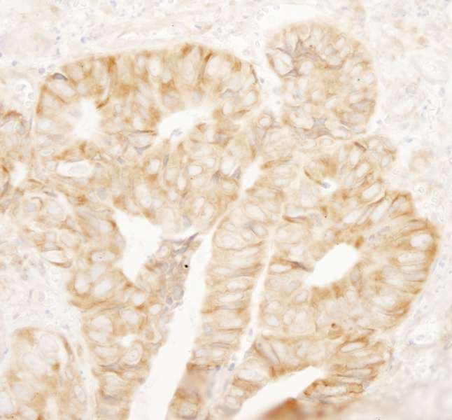 Detection of Human rpL7a/SURF3 by Immunohistochemistry. Sample: FFPE section of human colon carcinoma. Antibody: Affinity purified rabbit anti-rpL7a/SURF3 used at a dilution of 1:250. Epitope Retrieval Buffer-High pH (IHC-101J) was substituted for Epitope Retrieval Buffer-Reduced pH.