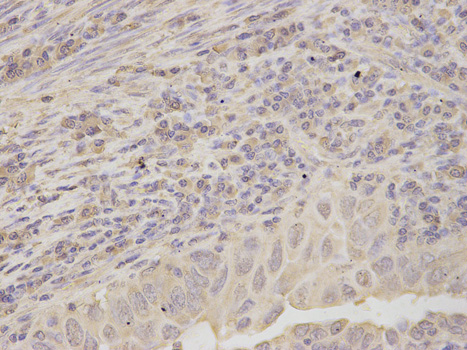Immunohistochemistry of paraffin-embedded human endometrial cancer using RPLP0 antibody at dilution of 1:200 (400x lens).