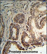 Formalin-fixed and paraffin-embedded human Prostate carcinoma reacted with RPLP0 Antibody (Center), which was peroxidase-conjugated to the secondary antibody, followed by DAB staining.