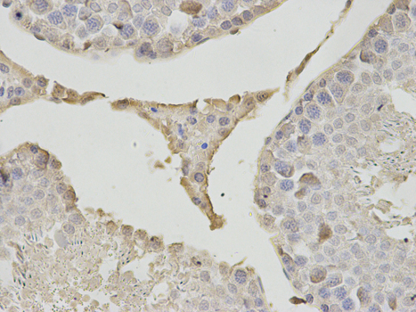 Immunohistochemistry of paraffin-embedded human breast cancer using PSMB1 antibody at dilution of 1:200 (400x lens).