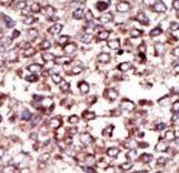 Formalin-fixed and paraffin-embedded human cancer tissue reacted with the primary antibody, which was peroxidase-conjugated to the secondary antibody, followed by DAB staining. This data demonstrates the use of this antibody for immunohistochemistry; clinical relevance has not been evaluated. BC = breast carcinoma; HC = hepatocarcinoma.