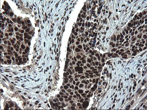 IHC of paraffin-embedded Carcinoma of Human lung tissue using anti-RPRD1B mouse monoclonal antibody. (Heat-induced epitope retrieval by 1 mM EDTA in 10mM Tris, pH8.5, 120°C for 3min).