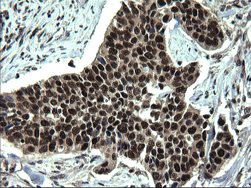IHC of paraffin-embedded Carcinoma of Human bladder tissue using anti-RPRD1B mouse monoclonal antibody. (Heat-induced epitope retrieval by 1 mM EDTA in 10mM Tris, pH8.5, 120°C for 3min).