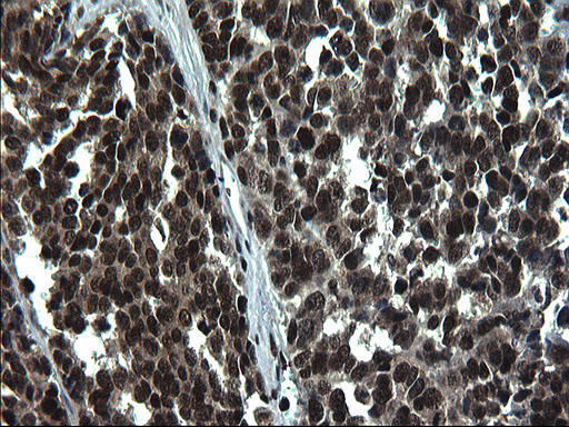 IHC of paraffin-embedded Adenocarcinoma of Human colon tissue using anti-RPRD1B mouse monoclonal antibody. (Heat-induced epitope retrieval by 1 mM EDTA in 10mM Tris, pH8.5, 120°C for 3min).