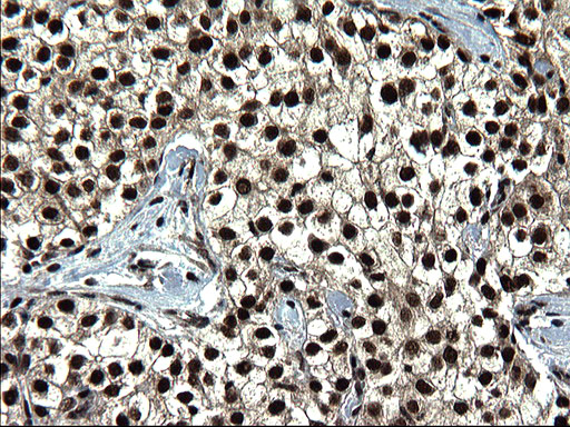 IHC of paraffin-embedded Carcinoma of Human liver tissue using anti-RPRD1B mouse monoclonal antibody. (Heat-induced epitope retrieval by 1 mM EDTA in 10mM Tris, pH8.5, 120°C for 3min).