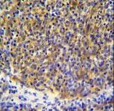 PSMB11 Antibody immunohistochemistry of formalin-fixed and paraffin-embedded human thymoma followed by peroxidase-conjugated secondary antibody and DAB staining.
