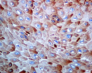IHC of paraffin-embedded human cervical carcinoma tissue using anti-RPS20 antibody.