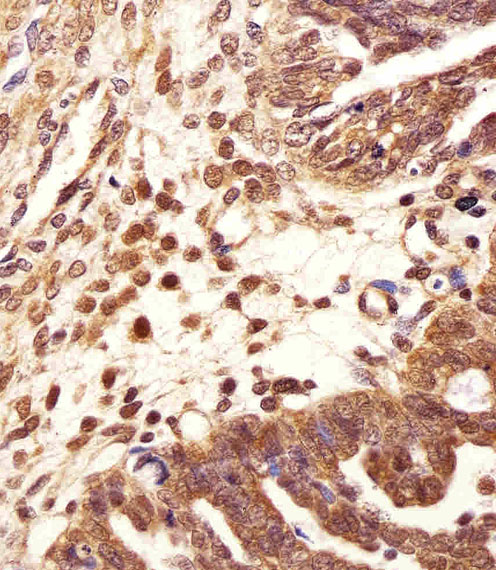 Immunohistochemical of paraffin-embedded H. ovarian carcinoma section using PSMB2 Antibody. Antibody was diluted at 1:25 dilution. A undiluted biotinylated goat polyvalent antibody was used as the secondary, followed by DAB staining.
