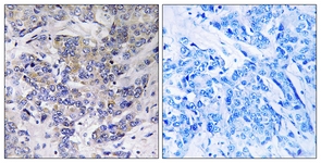 IHC of paraffin-embedded human breast carcinoma tissue, using RPS21 Antibody. The sample on the right was incubated with synthetic peptide.