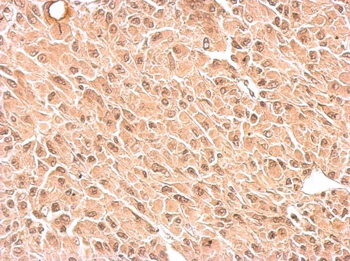 RPS3A antibody detects RPS3A protein at cytosol and nucleus on U87 xenograft by immunohistochemical analysis. Sample: Paraffin-embedded U87 xenograft. RPS3A antibody dilution:1:500.