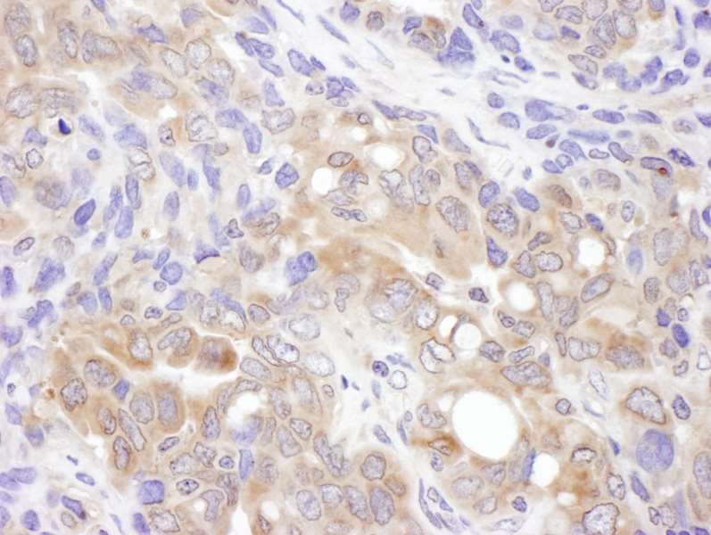 Detection of Human VCIP135 by Immunohistochemistry. Sample: FFPE section of human ovarian carcinoma. Antibody: Affinity purified rabbit anti-VCIP135 used at a dilution of 1:200 (1 ug/ml). Detection: DAB.