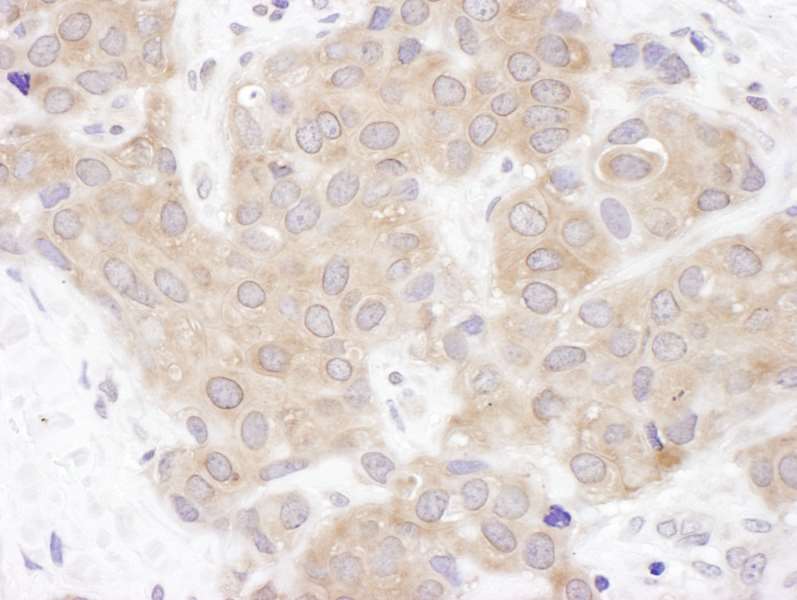 Detection of Human VCIP135 by Immunohistochemistry. Sample: FFPE section of human breast carcinoma. Antibody: Affinity purified rabbit anti-VCIP135 used at a dilution of 1:200 (1 ug/ml). Detection: DAB.