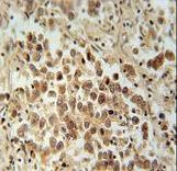 VCX1 Antibody immunohistochemistry of formalin-fixed and paraffin-embedded human testis carcinoma followed by peroxidase-conjugated secondary antibody and DAB staining.