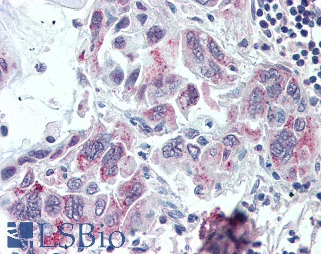 Anti-TMPRSS4 antibody IHC of human Pancreas, Carcinoma. Immunohistochemistry of formalin-fixed, paraffin-embedded tissue after heat-induced antigen retrieval.