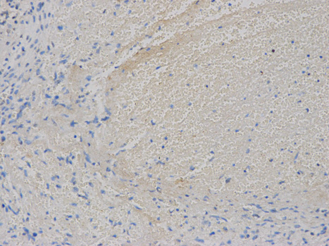 Immunohistochemistry of paraffin-embedded human spleen hematoma using VEGFB antibody at dilution of 1:200 (200x lens).