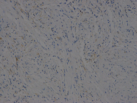 Immunohistochemistry of paraffin-embedded human stomach cancer using VEGFB antibody at dilution of 1:200 (200x lens).