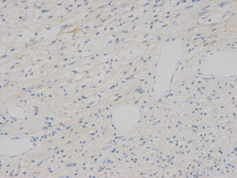 Immunohistochemistry of paraffin-embedded human Neurilemmoma using VEGFB antibody at dilution of 1:200 (200x lens).