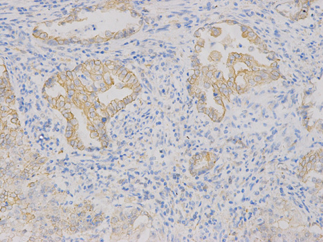 Immunohistochemistry of paraffin-embedded human endometrial cancer using VEGFB antibody at dilution of 1:200 (200x lens).
