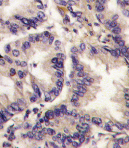 Formalin-fixed and paraffin-embedded human lung carcinoma tissue reacted with VEGF3 Antibody (Center M263), which was peroxidase-conjugated to the secondary antibody, followed by DAB staining. This data demonstrates the use of this antibody for immunohistochemistry; clinical relevance has not been evaluated.