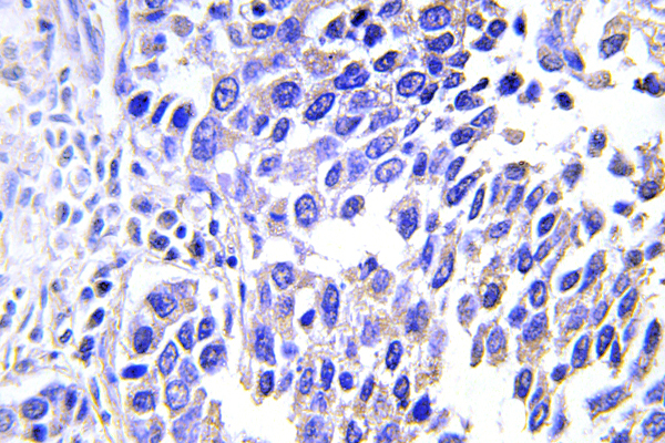 IHC of VGF (K458) pAb in paraffin-embedded human lung carcinoma tissue.
