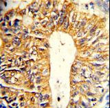 Formalin-fixed and paraffin-embedded human colon carcinoma reacted with Villin-1 Antibody , which was peroxidase-conjugated to the secondary antibody, followed by DAB staining. This data demonstrates the use of this antibody for immunohistochemistry; clinical relevance has not been evaluated.