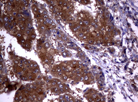 IHC of paraffin-embedded Carcinoma of Human liver tissue using anti-VSNL1 mouse monoclonal antibody. (Heat-induced epitope retrieval by 10mM citric buffer, pH6.0, 120°C for 3min).