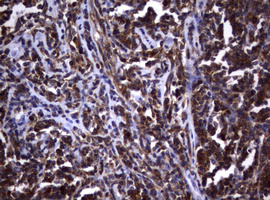 IHC of paraffin-embedded Human lymphoma tissue using anti-VSNL1 mouse monoclonal antibody. (Heat-induced epitope retrieval by 10mM citric buffer, pH6.0, 120°C for 3min).