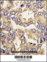 Formalin-fixed and paraffin-embedded human breast carcinoma tissue reacted with VILIP1 antibody , which was peroxidase-conjugated to the secondary antibody, followed by DAB staining. This data demonstrates the use of this antibody for immunohistochemistry; clinical relevance has not been evaluated.
