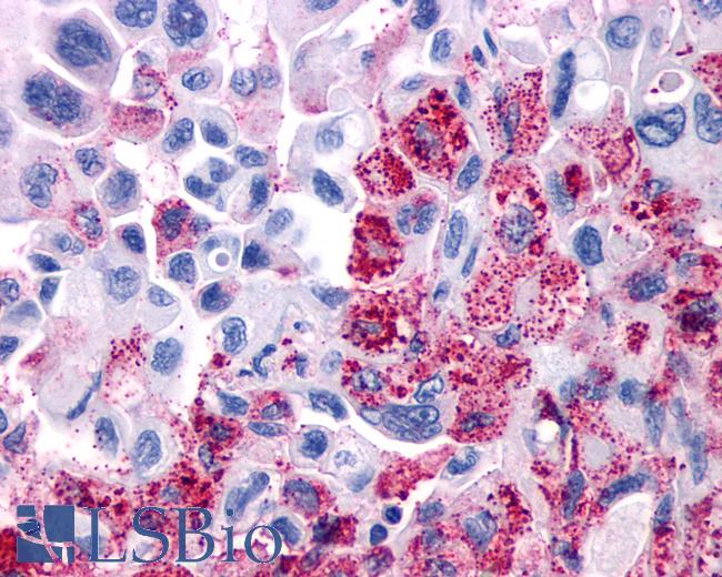Anti-VIPR1 / RDC1 antibody IHC of human Pancreas, Carcinoma. Immunohistochemistry of formalin-fixed, paraffin-embedded tissue after heat-induced antigen retrieval.