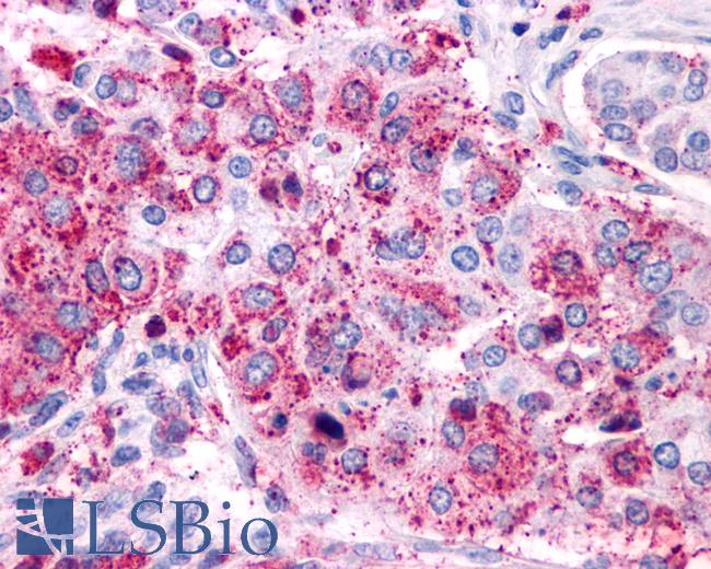 Anti-VIPR1 / RDC1 antibody IHC of human Lung, Adenocarcinoma. Immunohistochemistry of formalin-fixed, paraffin-embedded tissue after heat-induced antigen retrieval.