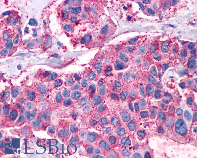 Anti-VIPR1 / RDC1 antibody IHC of human Breast, Carcinoma. Immunohistochemistry of formalin-fixed, paraffin-embedded tissue after heat-induced antigen retrieval.