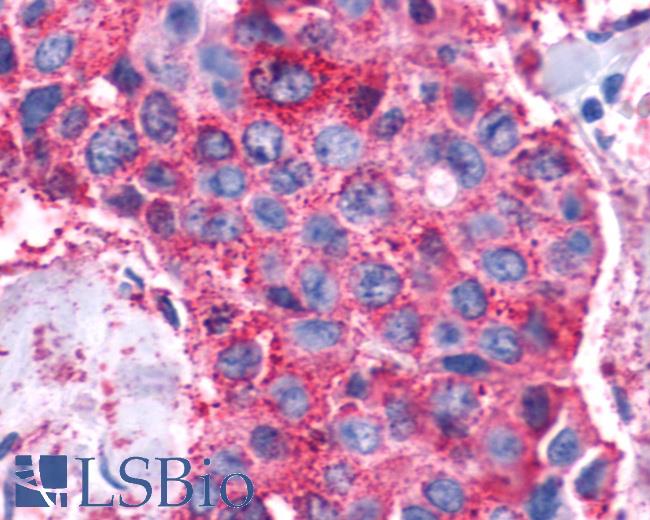 Anti-VIPR1 / RDC1 antibody IHC of human Breast, Carcinoma. Immunohistochemistry of formalin-fixed, paraffin-embedded tissue after heat-induced antigen retrieval.