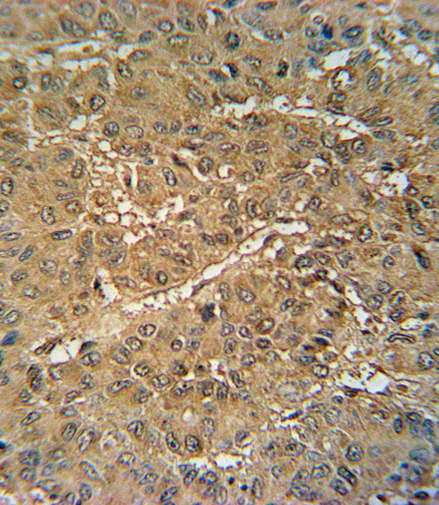 VKORC1 Antibody immunohistochemistry of formalin-fixed and paraffin-embedded human hepatocarcinoma followed by peroxidase-conjugated secondary antibody and DAB staining.